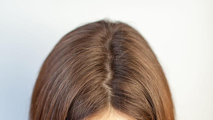 Kafanız hatır çok kaşınıyorsa çaresi var!